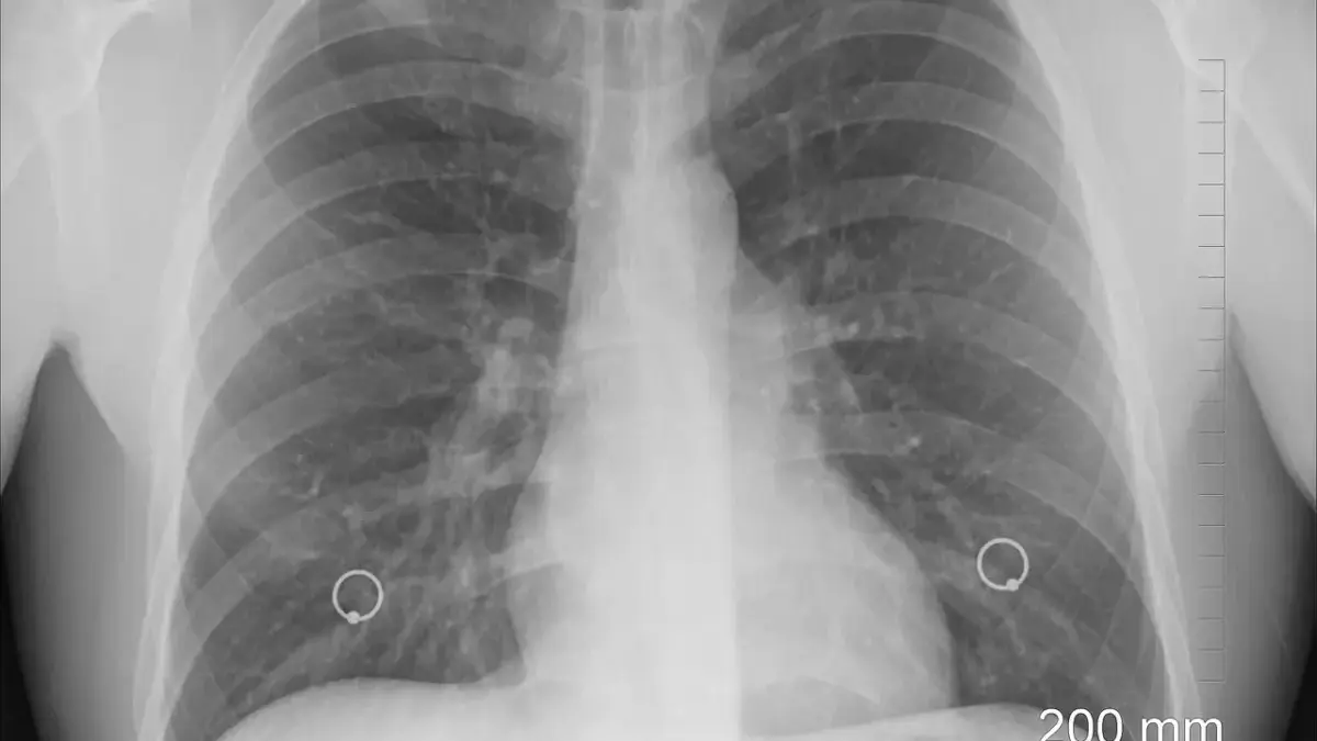 mi a pulmonológia